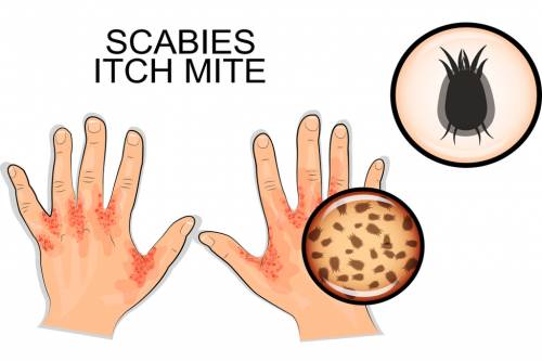 Home Remedies for Scabies