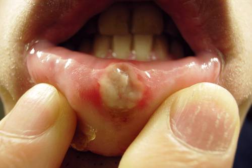 Home Remedies for Stomatitis
